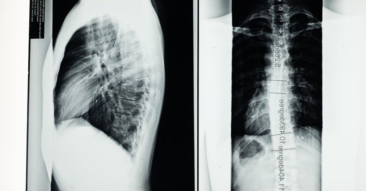 descubre estrategias efectivas para la prevención de la escoliosis. aprende sobre ejercicios, posturas correctas y consejos para mantener una columna vertebral saludable desde una edad temprana.