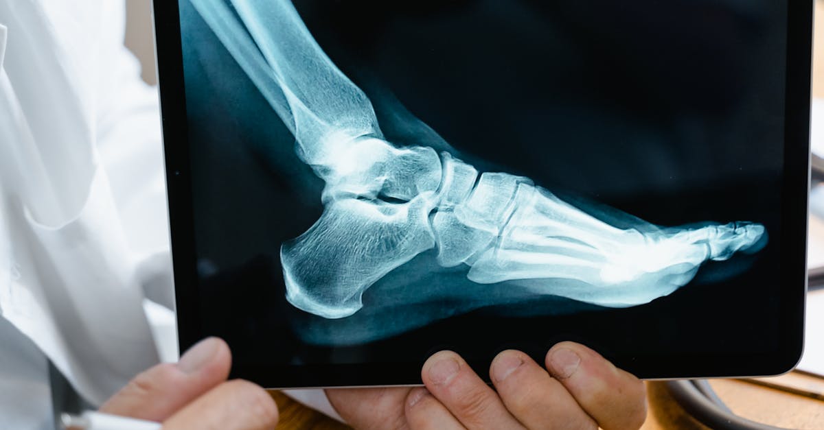 les lesiones del plexo braquial son complicaciones graves que afectan los nervios responsables del movimiento y la sensación en el brazo. esta guía explora sus causas, síntomas y opciones de tratamiento para ayudar a los afectados a comprender y gestionar mejor su recuperación.