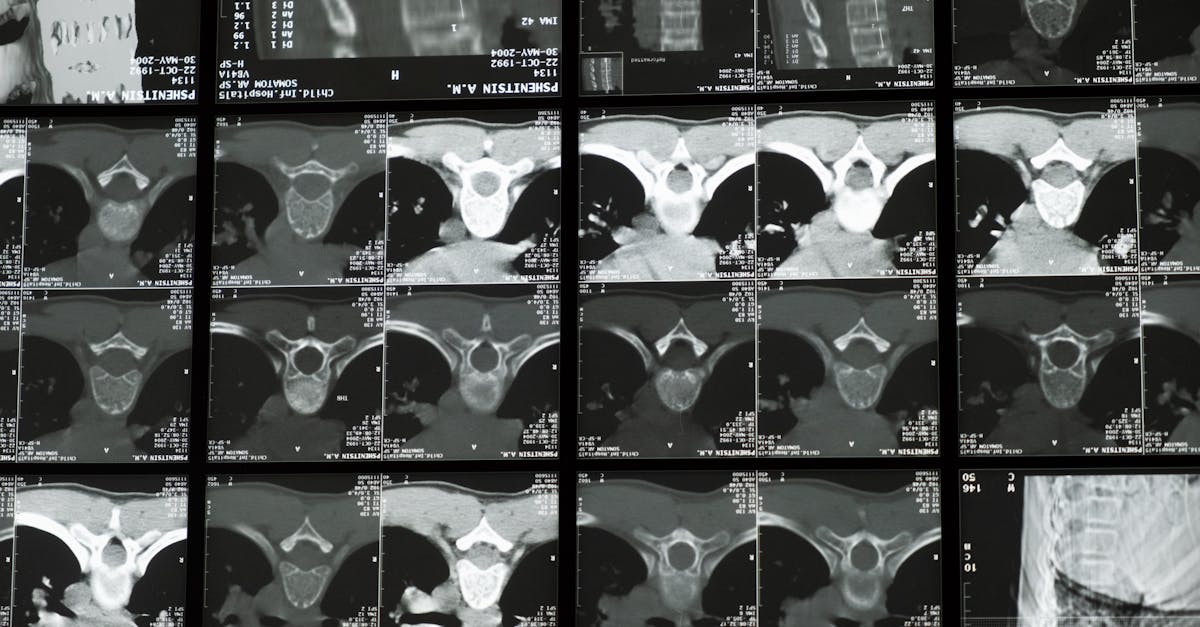 descubre las causas y tratamientos para los espasmos cervicales, un problema común que puede causar dolor y malestar. aprende cómo aliviar los síntomas y mejorar tu calidad de vida.