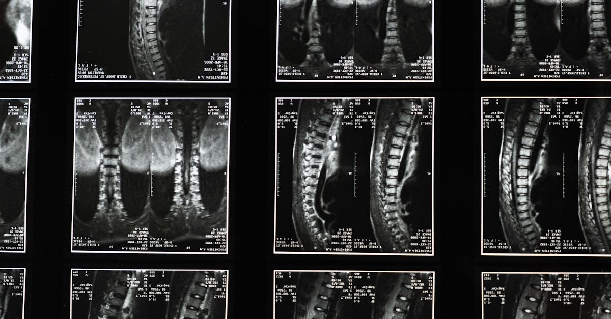 la escoliosis es una condición médica que provoca una curvatura anormal de la columna vertebral. descubre sus causas, síntomas y tratamientos para mejorar la calidad de vida de quienes la padecen.