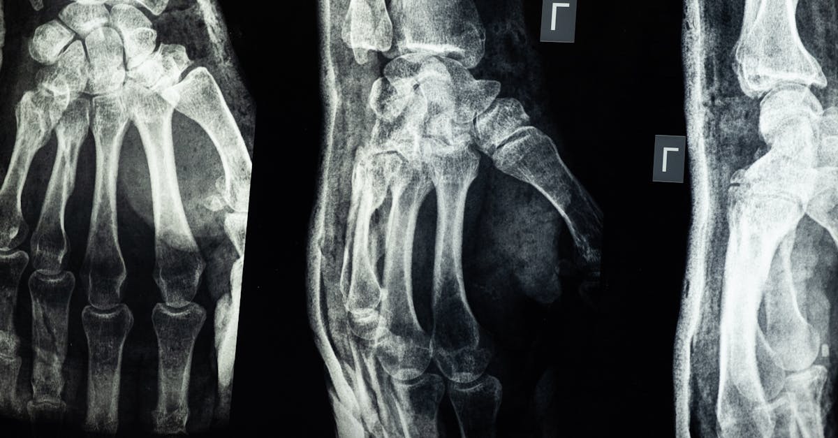 lesión del plexo braquial: comprensión, síntomas y tratamientos de una condición que afecta la función del brazo y la mano. conozca más sobre las causas y las opciones de recuperación.
