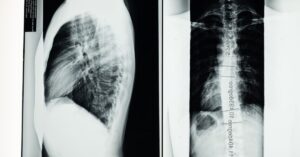 descubre todo sobre la escoliosis: causas, síntomas y tratamientos para esta curvatura anormal de la columna vertebral. infórmate sobre cómo manejar y mejorar tu calidad de vida con esta condición.