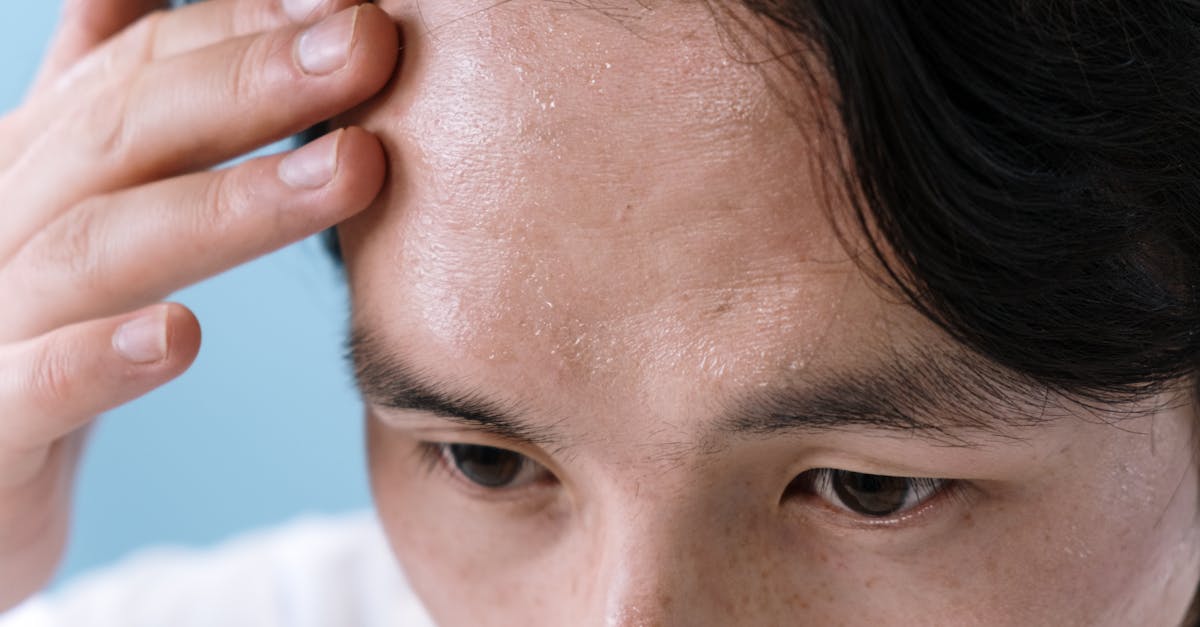 descubre todo sobre las cefaleas tensionales: síntomas, causas y tratamientos eficaces para aliviar el dolor de cabeza y mejorar tu calidad de vida.